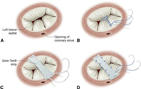A Common Atrioventricular Valve Anatomy Surgical View B The