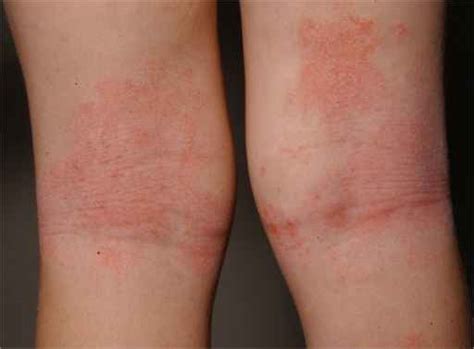 Dermatitis Atopik Patofisiologi Diagnosis Penatalaksanaan Alomedika The Best Porn Website