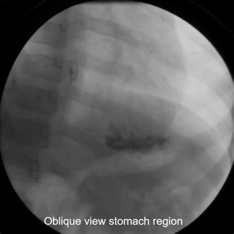 Second Branchial Cleft Cyst With Fistula Radiology Cases