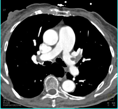 Multiple Bilateral Pulmonary Embolism Chest Case Studies Ctisus Ct