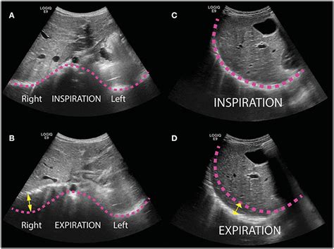 Frontiers A Novel Thoracic Ultrasound Measurement After Congenital