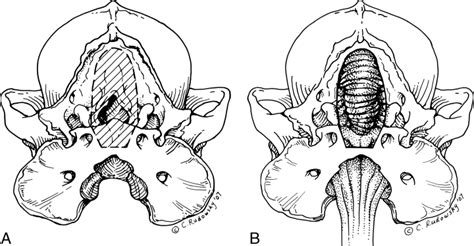 Foramen Magnum Decompression With Cranioplasty For Treatment Of Caudal