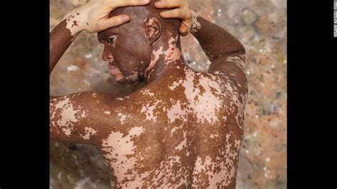 Well, the game is not so big. VITILIGO: The Skin Condition You Should Know About ...