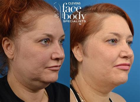 Before And After Photo Of Our Patient Click On The Picture To Learn
