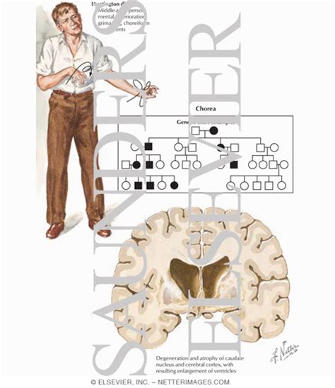 Since 1999, the huntington's disease society of america has committed more than $20 million to fund research, with the goal of finding effective treatments to slow huntington's disease. Huntington's Disease