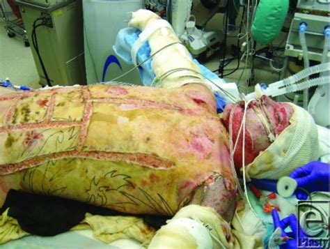 Escharotomy — surgical incision in an eschar (necrotic dermis) to lessen constriction, especially after a circumferential third degree burn of an extremity or the thorax. Chest and abdominal wall escharotomies. | Open-i