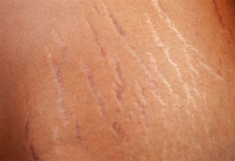 5 Home Cures For Stretch Marks Organic Health And Beauty