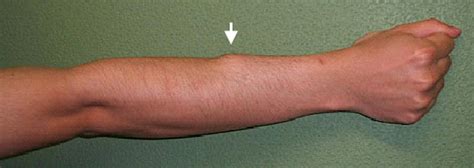 Snapping Wrist Caused By Tenosynovitis Of The Extensor Carpi Radialis