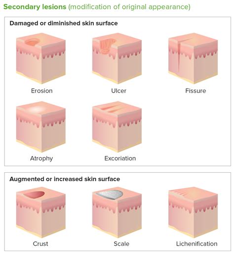 Classification Of Skin Lesions Into Seven Classes Usi