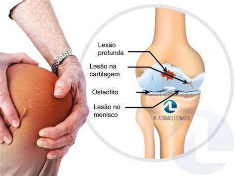 Afastamento Por Lesao No Joelho