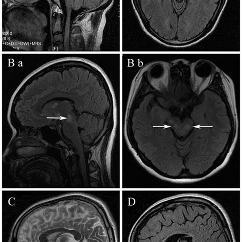 Brain Stem Lesions Arrows On Mri Of Multiple Sclerosis Ms A B