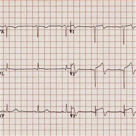 Wellens Syndrome Characterised By Inverted Biphasic T Waves Most