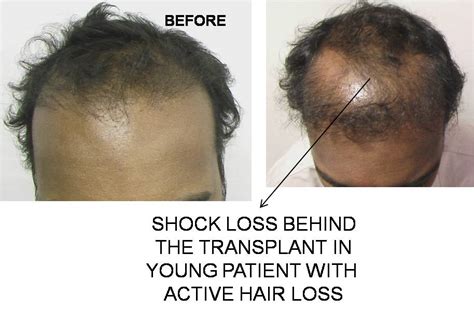 A physical or emotional shock can cause hair to loosen. Shock loss| Learn how hair transplants cause shock loss.