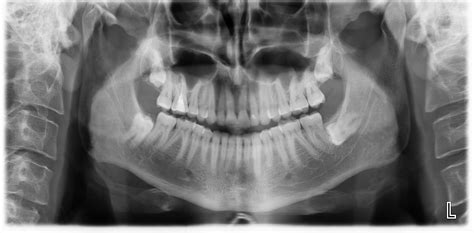 Tooth Impaction Wikidoc
