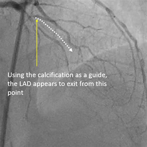 Wire Choice Asian Heart And Vascular Centre Ahvc