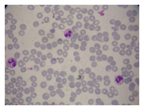 Blood Smear Showing Multiple Lipid Vacuoles In The Cytoplasms Of Three