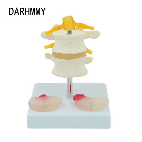 DARHMMY Human Lumbar Model With Diseased Intervertebral Discs Spinal Nerve Roots Skeletal