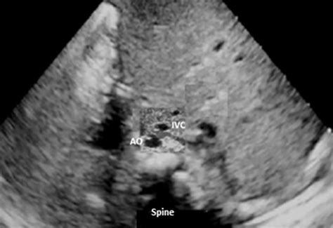 Subcostal Short Axis Echocardiographic Findings Showing The