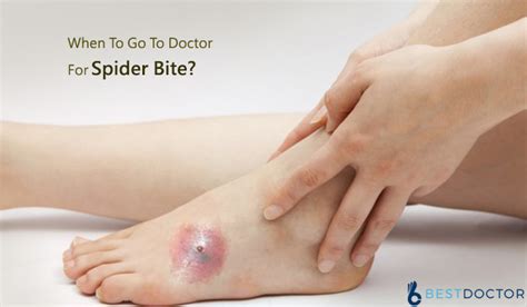 When To Go To Doctor For Spider Bite