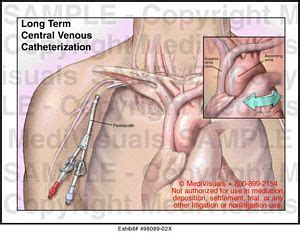 What are the types of regulation d offerings? Long Term Central Venous Catheterization Medical Illustration
