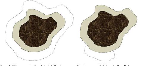 Figure 1 From Conventional Surgery Compared With Slow Mohs Micrographic