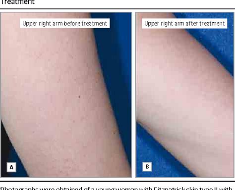 Figure From Treatment Of Keratosis Pilaris With Nm Diode Laser A