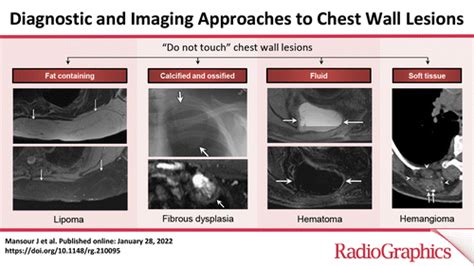 Diagnostic And Imaging Approaches To Chest Wall Lesions Radiographics
