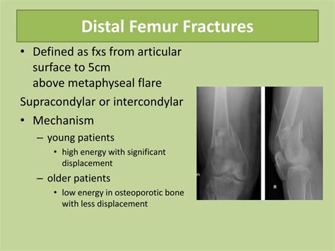 PPT - Common lower limb fracture PowerPoint Presentation ...