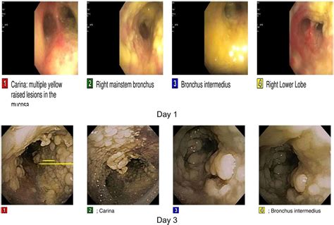 Average number of review reports. Fulminant tracheobronchial aspergillosis | BMJ Case Reports
