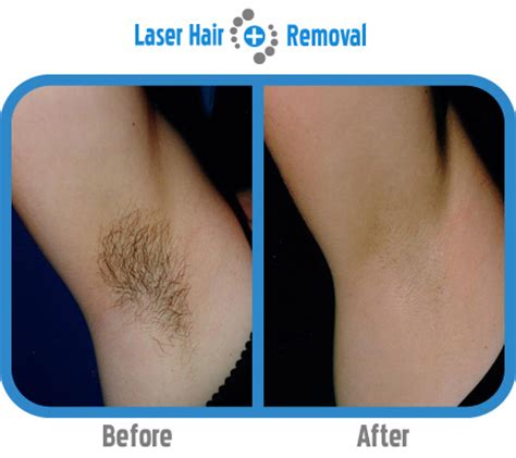 If the hair you want to be removed is one of these. Underarm Laser Hair Removal | Laser Hair Removal