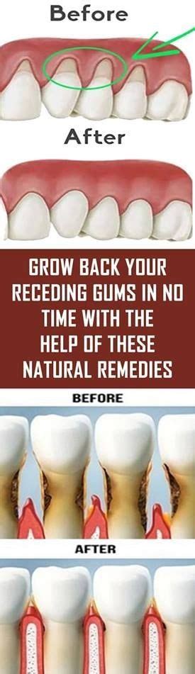 Grow Back Your Receding Gums With Natural Remedies