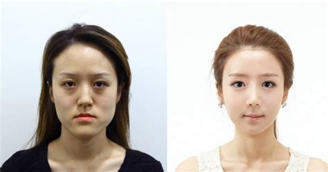 Plastic Surgery Transformations In Korea Continue To Impress Koreaboo