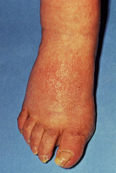 Rash And Swelling On Foot Due To Secondary Syphilis Photograph By Science Photo Library Pixels