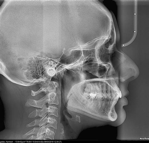 Lateral Ceph Radiodent Dental And Maxillofacial Imaging