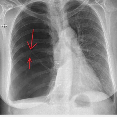 Chest X Ray Posteroanterior View On Admission Image Showing