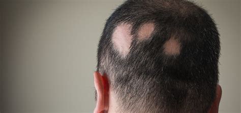 Alopecia Areata Dermatology And Skin Health Dr Mendese