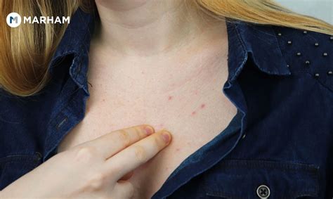 How To Get Rid Of Chest Acne Marham