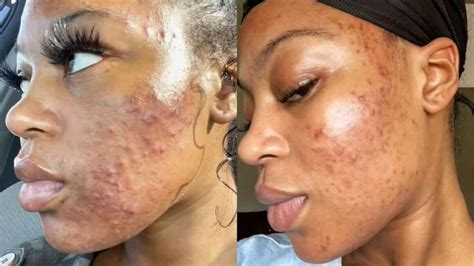 Chemical Peel Before And After Pictures And Videos Drug Genius