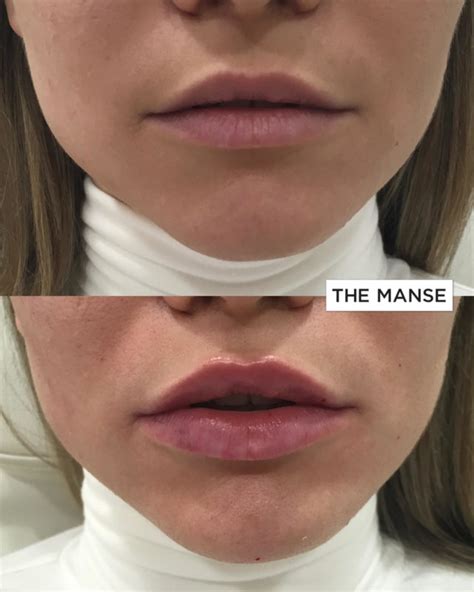 Russian Lips Best Clinic Sydney For Dermal Fillers