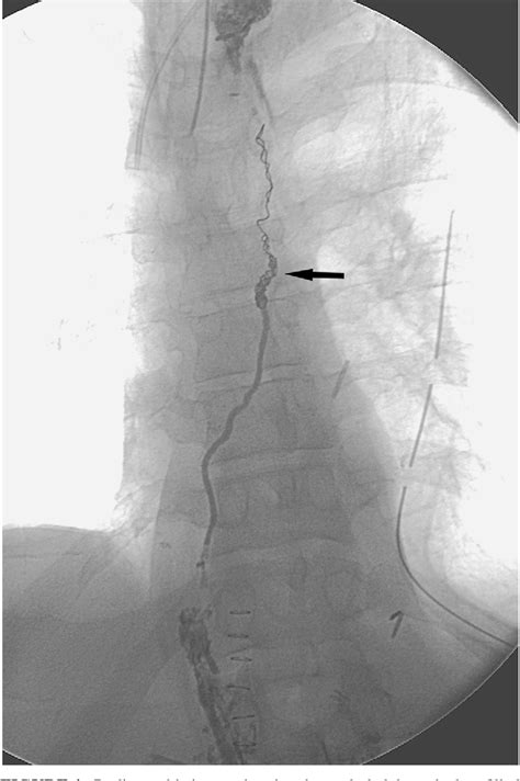 Figure 1 From Nonoperative Thoracic Duct Embolization For Traumatic