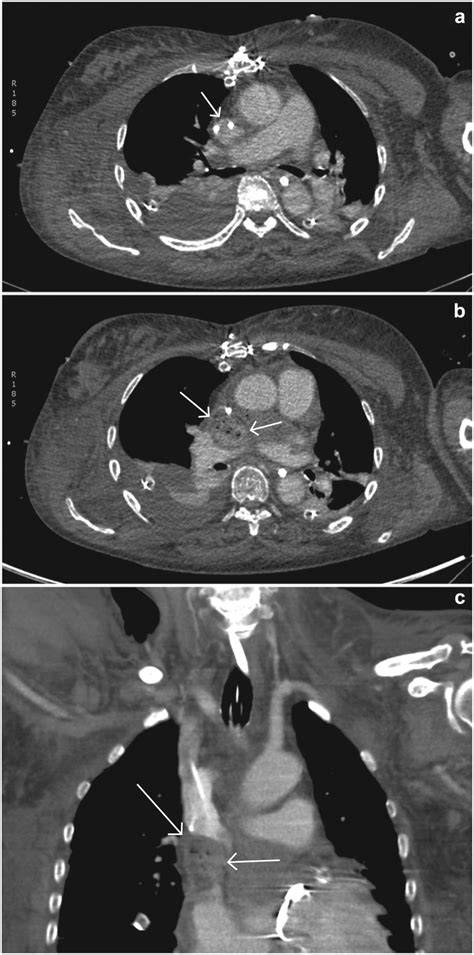 Contrast Enhanced Ct Scans Of The Same Patient As In Fig 1 That Were