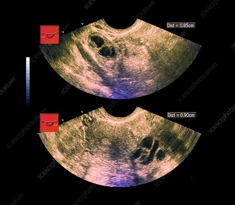 Ovarian Cysts Ultrasound Scan Stock Image M8500652 Science