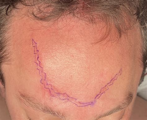 Plastic Surgery Case Study Geometic Scar Revision Of A Traumatic