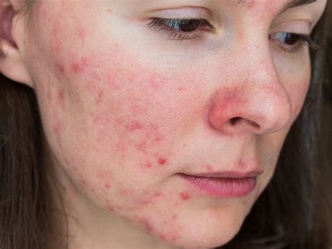 How To Prevent Acne Scars Sanford Dermatology