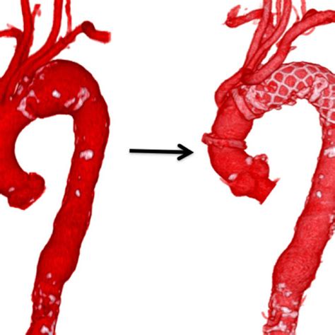 3d Ct Image Left Side Preoperative Distal Aortic Arch Aneurysm Right