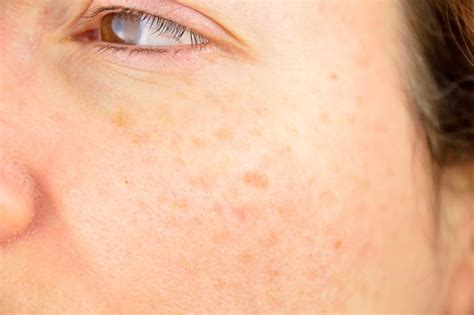 How To Recognize Different Skin Growths Ut Physicians