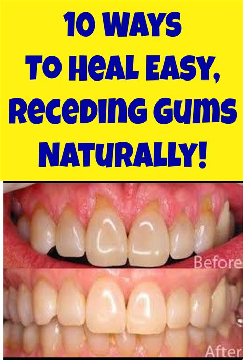 10 ways to heal easy receding gums naturally receding gums gum treatment gum care