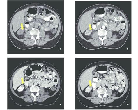 The Preoperative Triphasic Mdct Images Of A Renal Mass Located