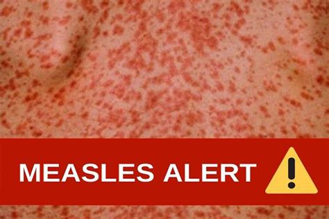 Measles Case On Brisbanes Northside The Prince Charles Hospital