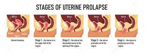 Etapas del prolapso uterino Ilustración vectorial